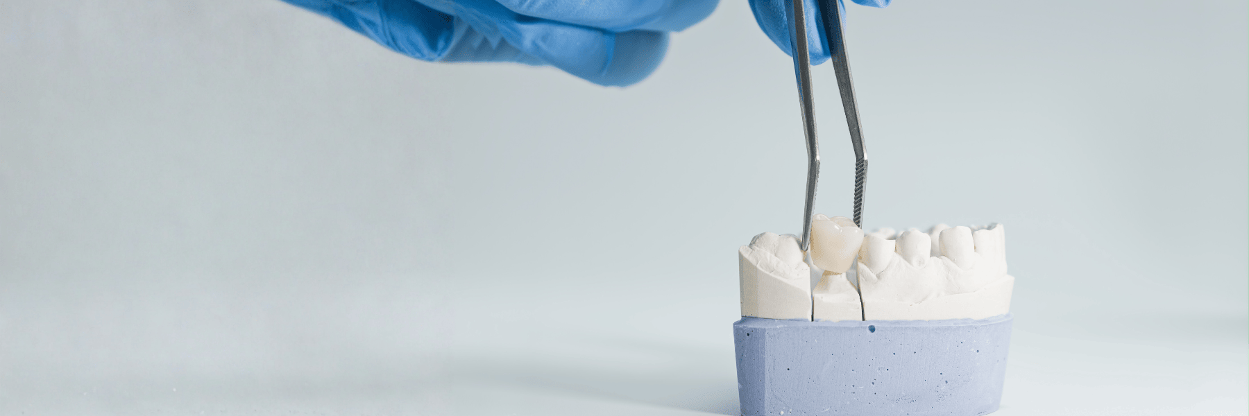 Crowns and Bridges | Dentist