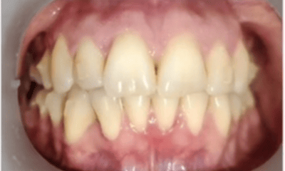 After treatment - 10-Month Smile Transformation