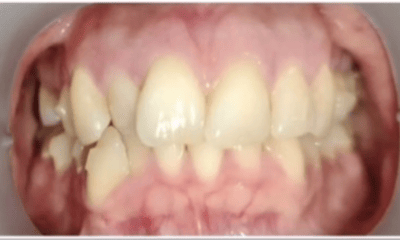 Before treatment - 10-Month Smile Transformation